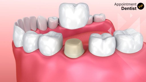 The Process of Getting a Dental Crown: Step by Step