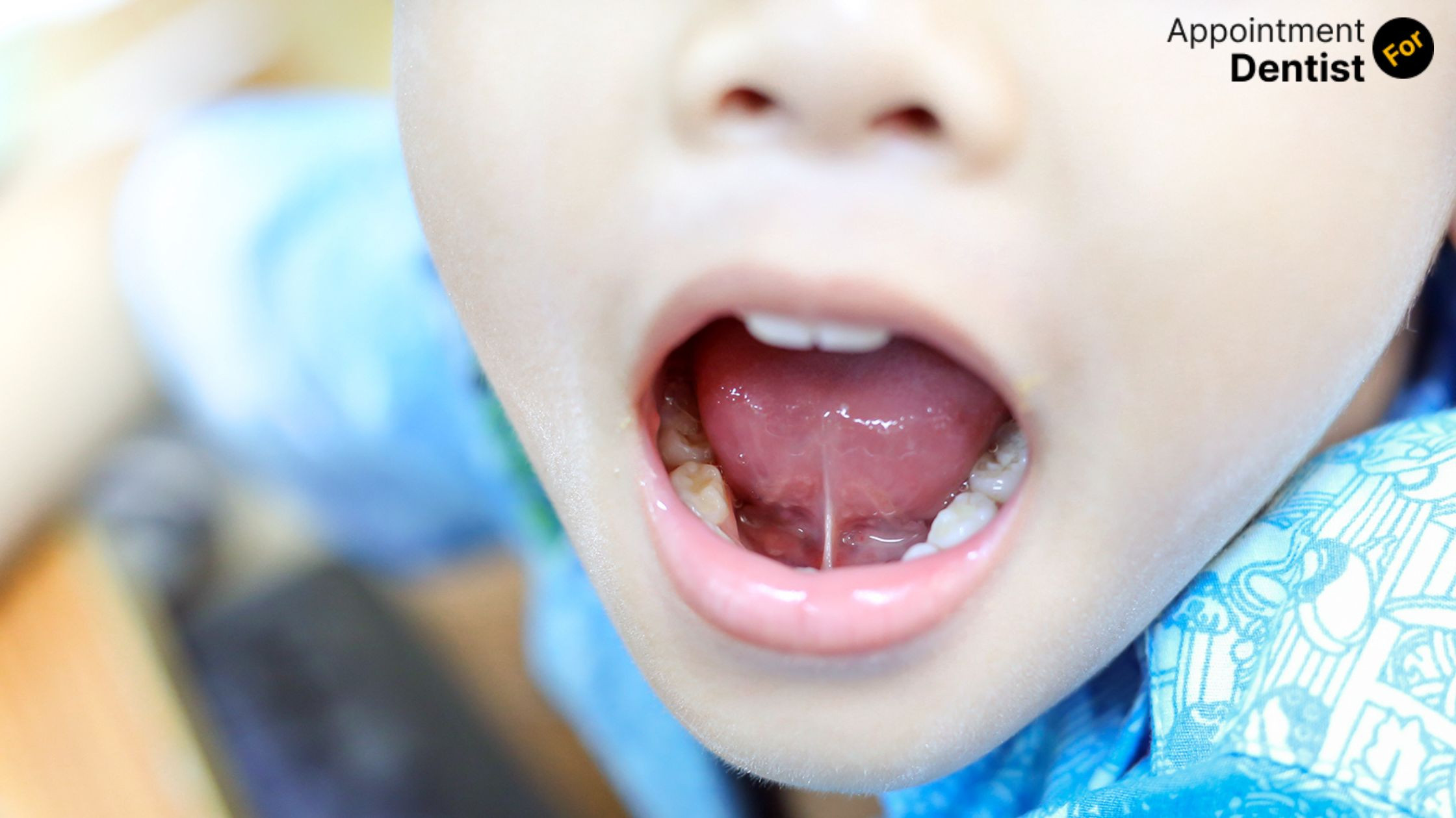 Signs and Symptoms of Tongue Tie in Infants, Children, and Adults