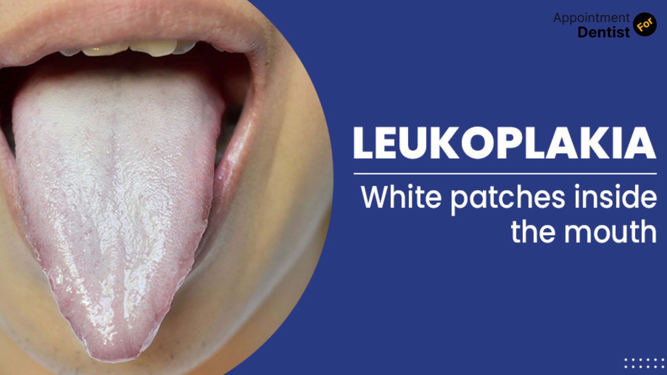 Exploring The Causes And Treatments Of Oral Leukoplakia Comprehensive Exploring The Causes And Treatments Of Oral Leukoplakia Comprehensive