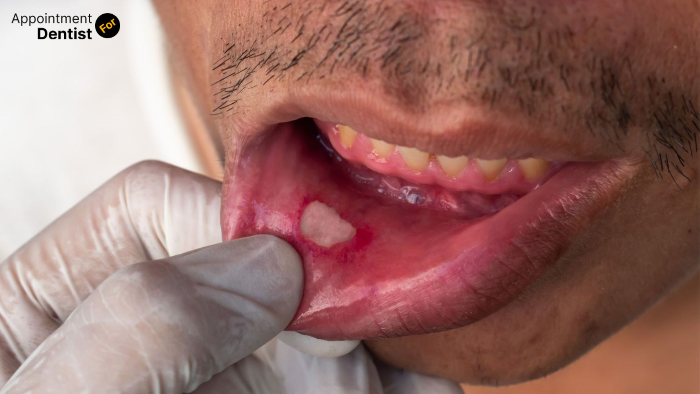 Treating and Preventing Recurrent Aphthous Stomatitis (Canker Sores)
