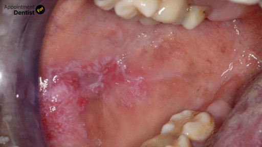 Understanding and Treating Oral Manifestations of Lupus