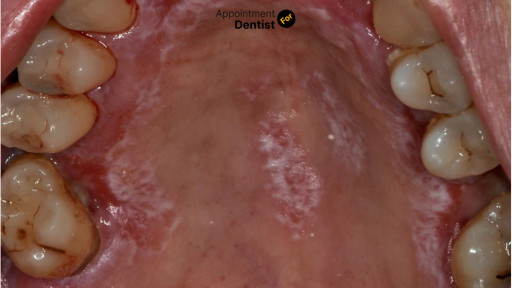 Exploring the Efficacy of Laser Therapy in Treating Oral Lesions