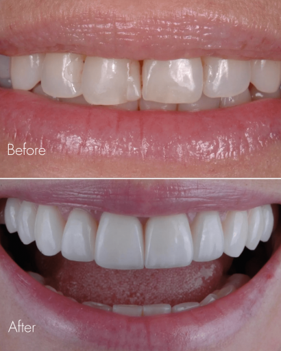 Why Are Veneers So Expensive in Miami? A Breakdown of the Costs